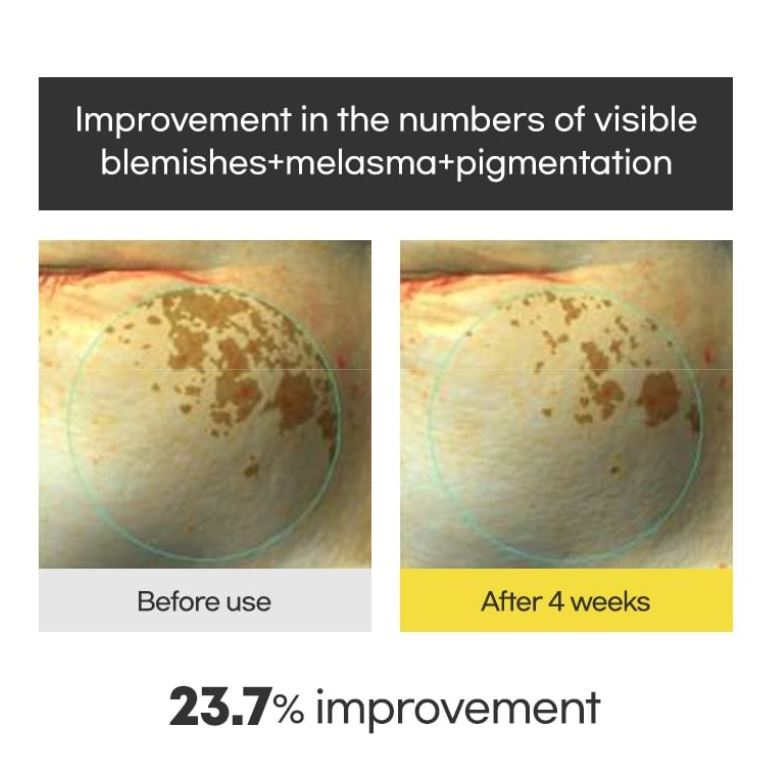 AMPLE: N Blemi Shot Cream – Improves Blemishes, Melasma, Pigmentation | SunSkincare