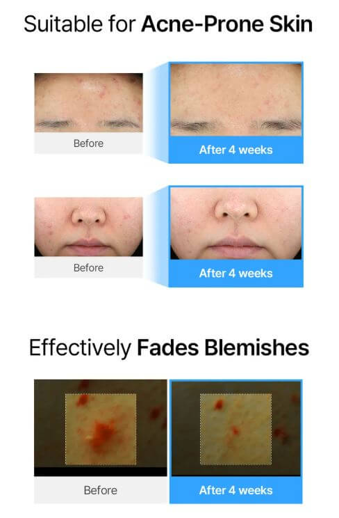 Klairs EGF Blue AC Calming Serum – Before and After | SunSkincare