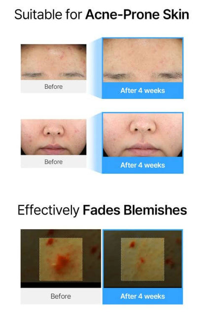 Klairs EGF Blue AC Calming Serum – Before and After | SunSkincare