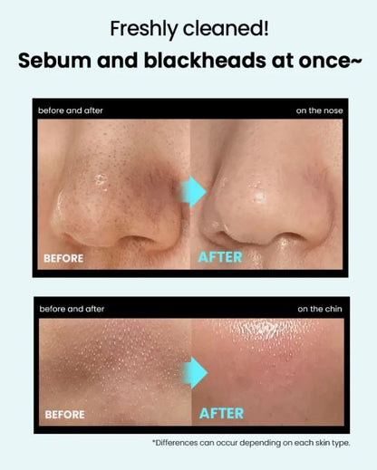 ilso Super Melting Sebum Softener | Before and After: Dissolve Stubborn Sebum & Blackheads | SunSkincare